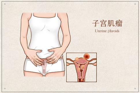 1677088575794752.jpg 攝圖網(wǎng)_401800161_banner_子宮肌瘤醫(yī)療插畫(企業(yè)商用).jpg