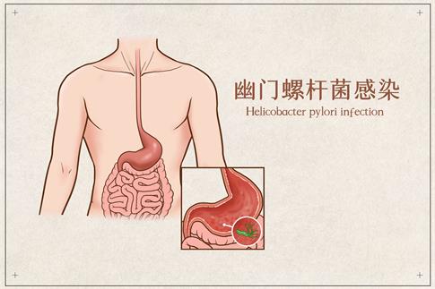 1678821641918760.jpg 攝圖網(wǎng)_401789751_banner_幽門螺桿菌感染醫(yī)療插畫(企業(yè)商用).jpg