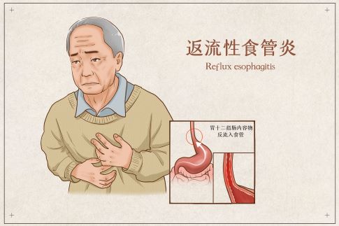 1705739233702908.jpg 攝圖網(wǎng)_401804083_反流性食管炎醫(yī)療插畫(huà)(企業(yè)商用).jpg